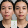 Acne Salicylic Acid 2.5% Serum 30ml | Advanced Acne Treatment | Deep Pore Cleansing, Oil Control, And Skin Clarifying Face Serum For All Skin Types - Image 4