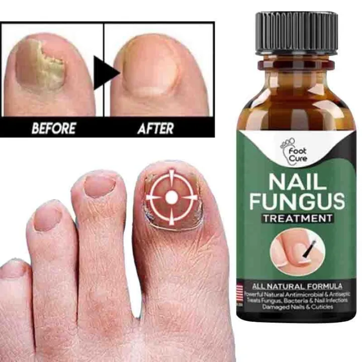 Fast Nail Fungus Treatment Gel – Nail Repair Essence Serum for Healthy, Smooth & Strong Nails - Image 4