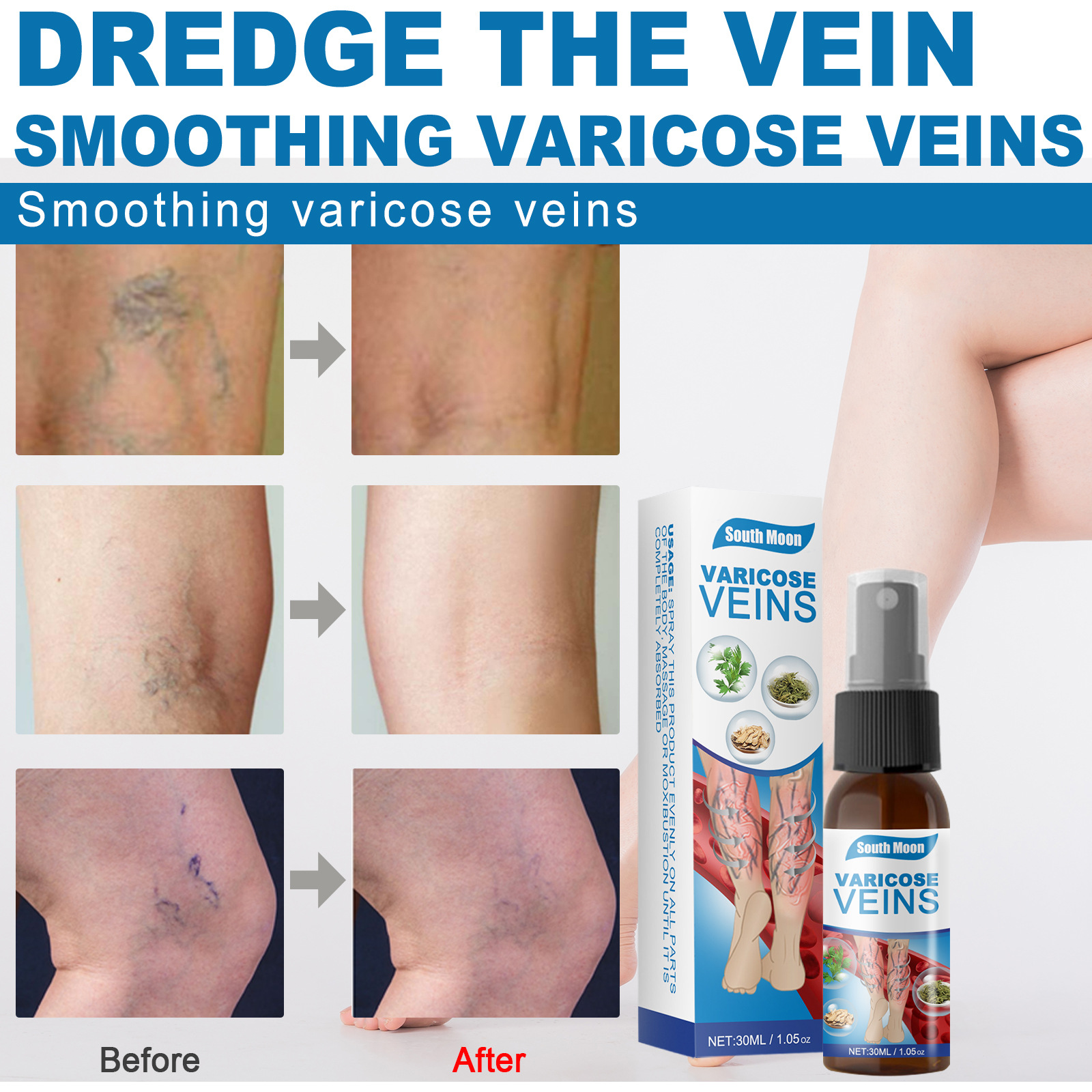 30ml Varicose Veins Treatment Spray Varicose Vein Treatment Cream Repair Varicocele Removal Pain Relief Kidney Inflammation Legs Vein Health Care Spray - Image 2