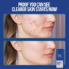 Wiki Special Anti Acne Serum – 30ml | Clears Acne