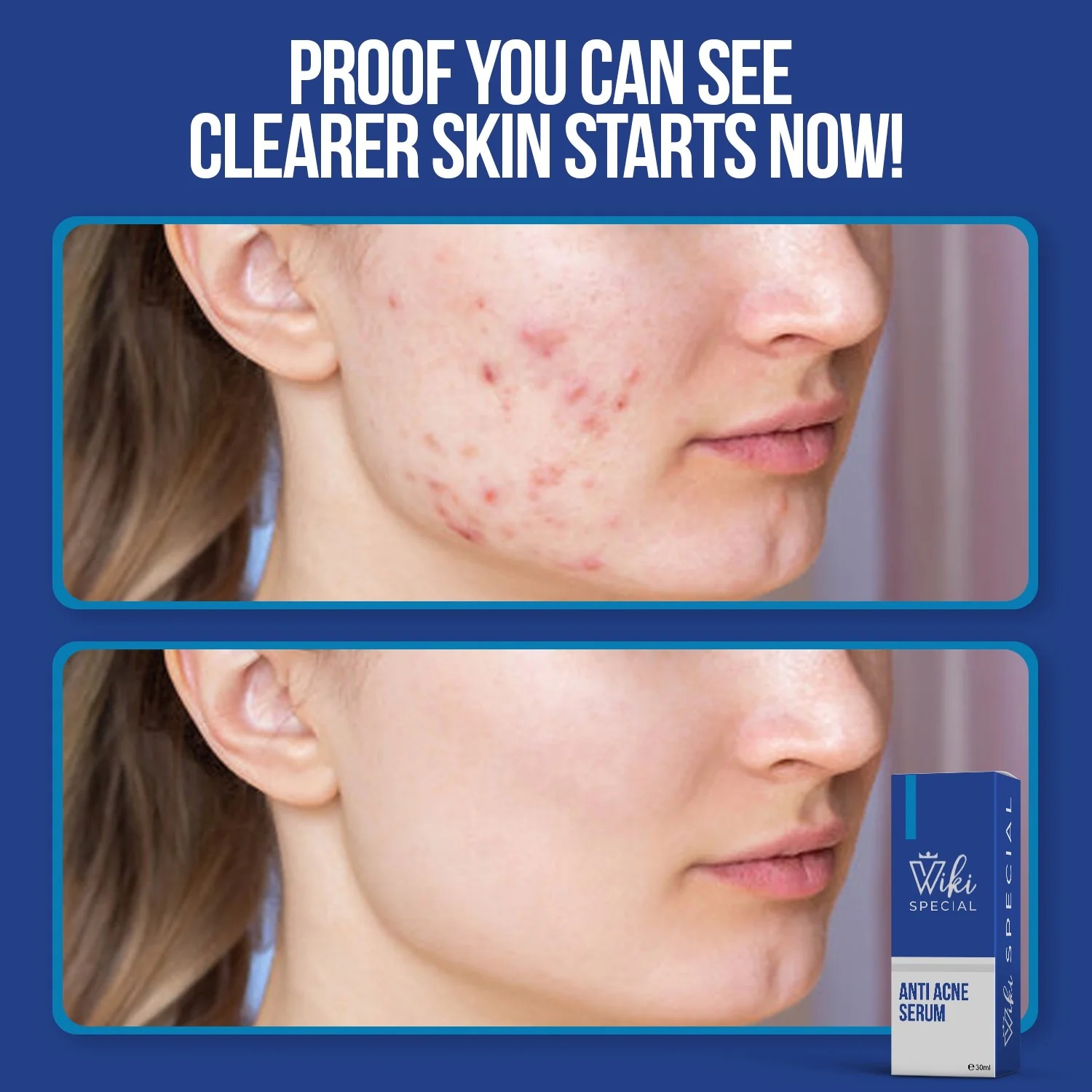 Wiki Special Anti Acne Serum – 30ml | Clears Acne