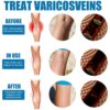 Varicose Veins Treatment Spray – Advanced Formula for Spider Veins