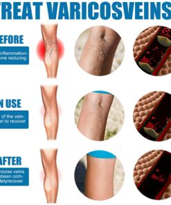 Varicose Veins Treatment Spray – Advanced Formula for Spider Veins