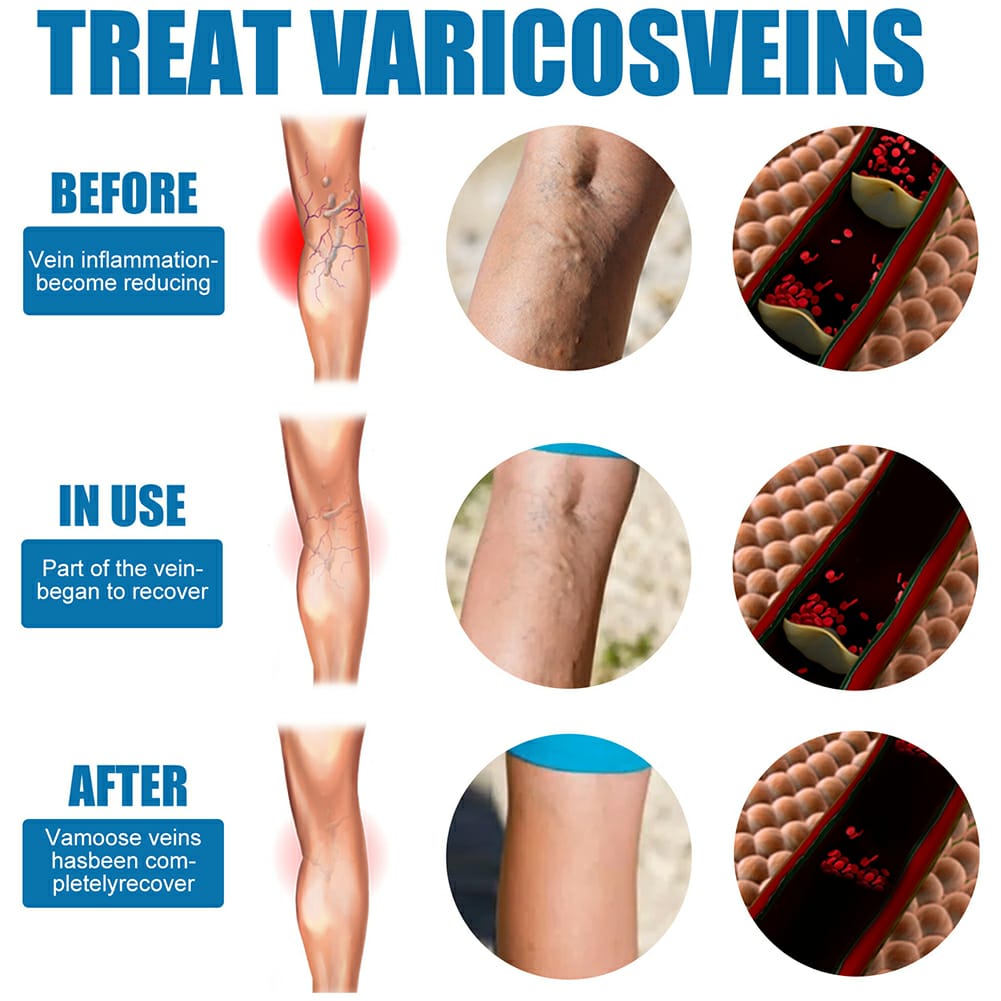 Varicose Veins Treatment Spray – Advanced Formula for Spider Veins, Leg Pain & Swelling Relief ~ 30ml - Image 3